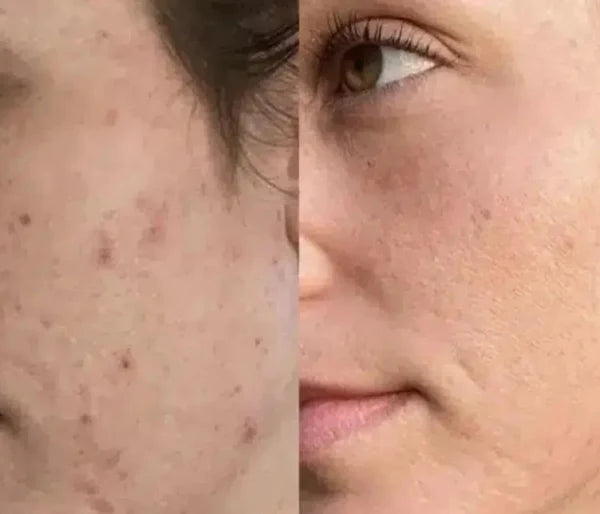 LED-mask före och efter, akne
