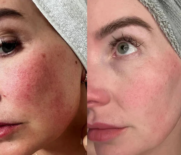 LED-mask före och efter, rodnad