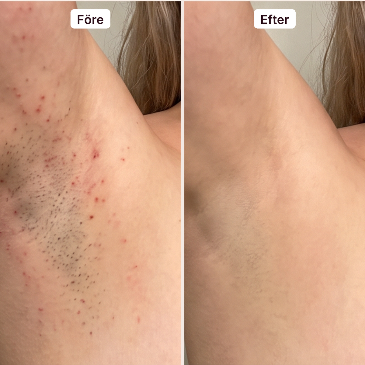 Elara IPL hårborttagning före och efter i armhålan