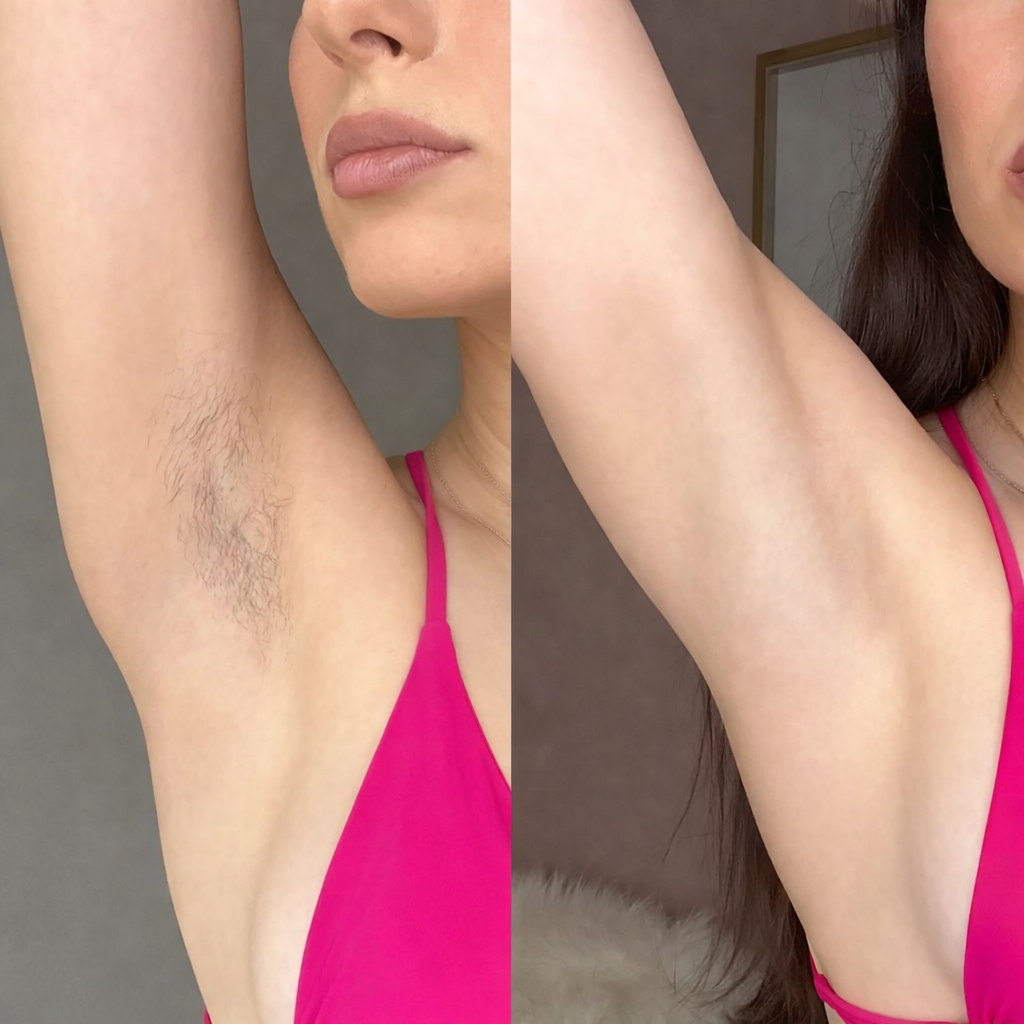 Före och efter IPL hårborttagning i armhålan