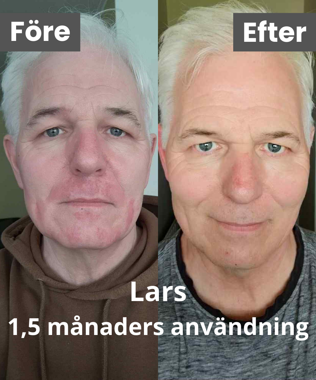 led mask före efter