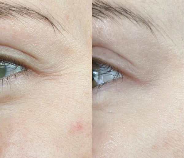 1. Wrinkles and fine lines