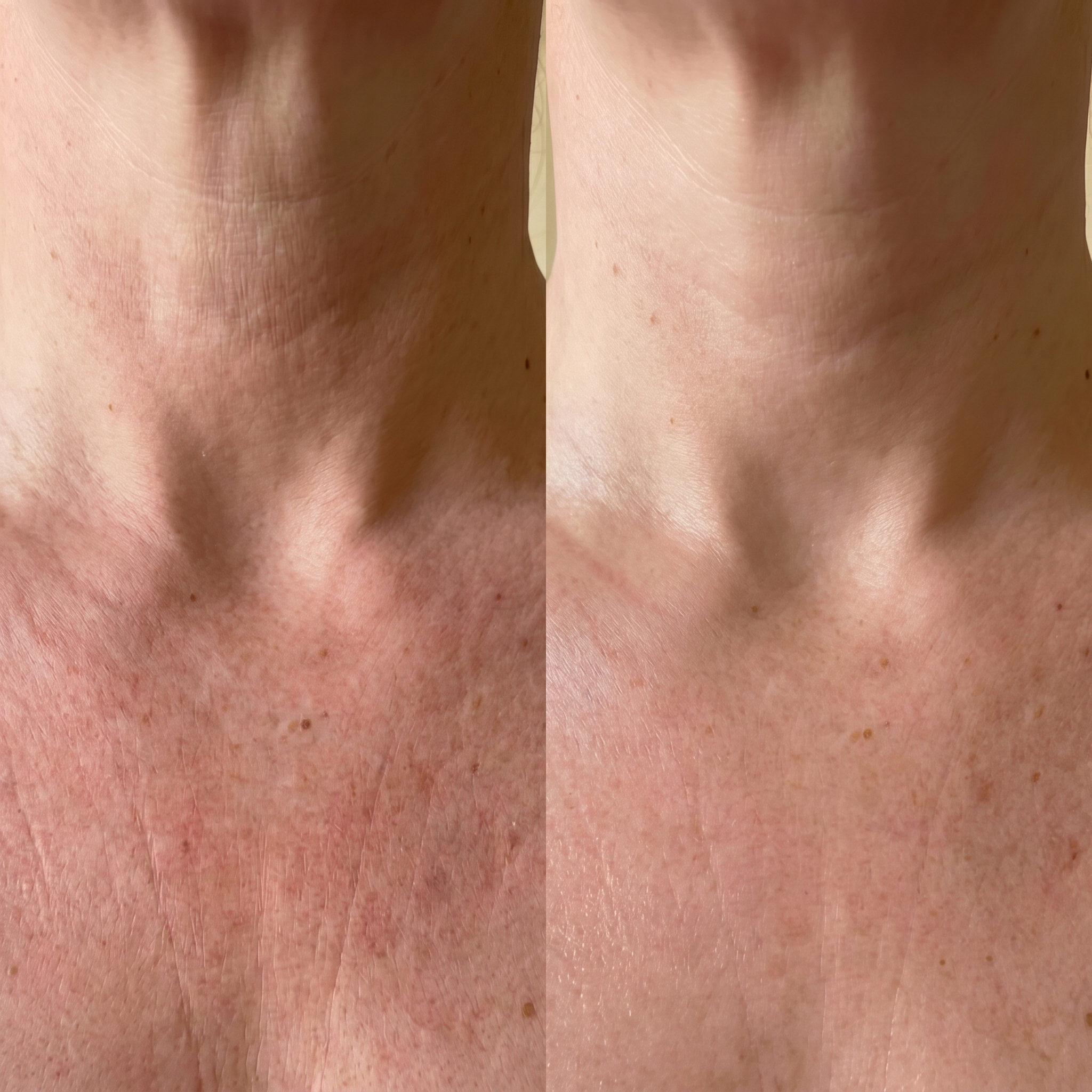 Nordic Flow Betterskin LED Hals & Décolletage